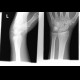 Abruption of triquetrum, transverse fracture of distal radius, abruption of unlar styloid process: X-ray - Plain radiograph